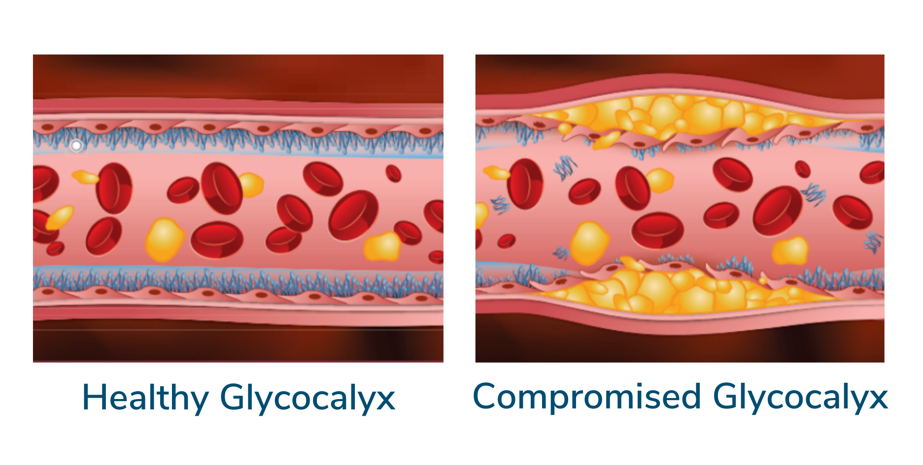 A healthy artery and its wall compared to a compromised artery with plaque buildup and glycocalyx degradation